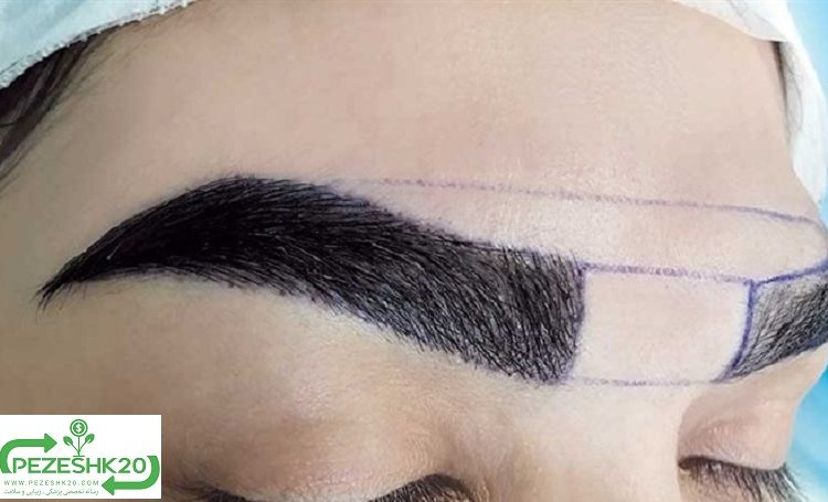 کاشت ابرو