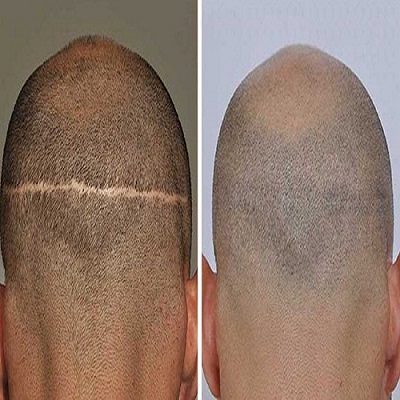 بهترین کلینیک کاشت مو در فردیس کرج