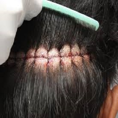 کاشت موی کورونال در کرج
